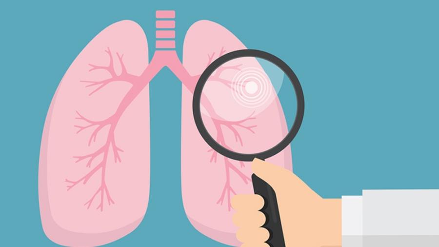 5491202208260432 Lung-Cancer-Screening