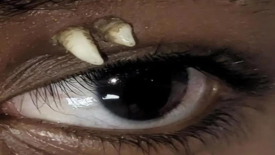 5613102273199706 7916ae4d-ectopic-tooth