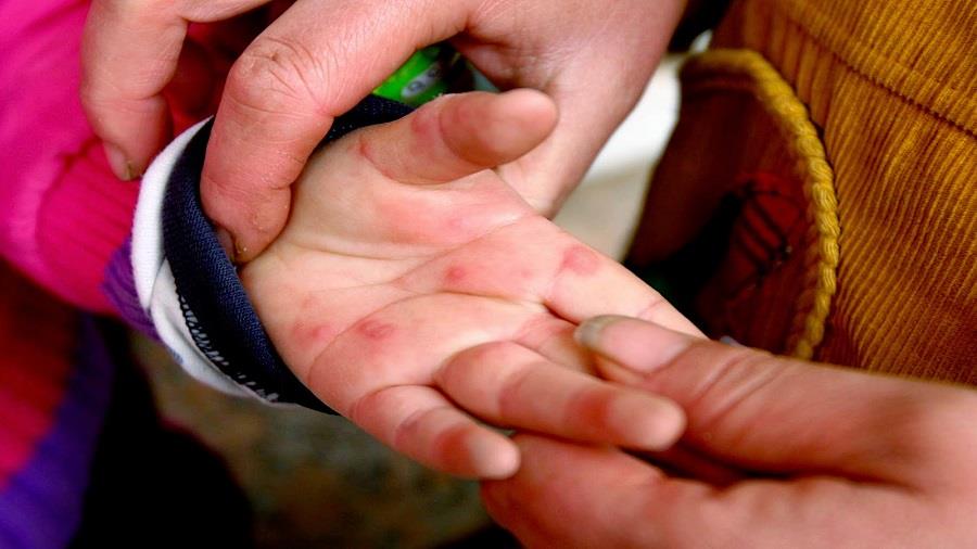 νοσος κοξακι