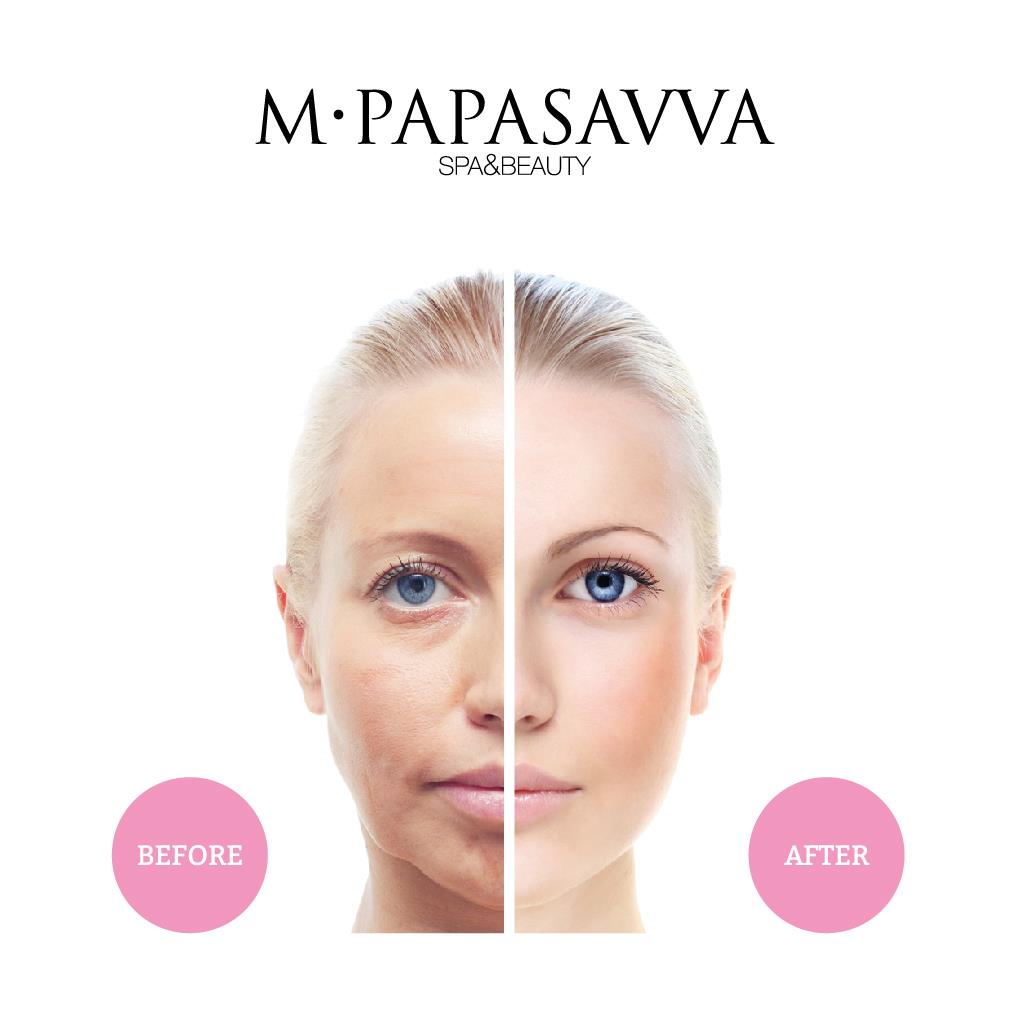 SPA_PAPASAVVA_HIFU_POSTS