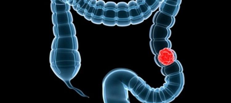καρκίνος του παχέως εντέρου