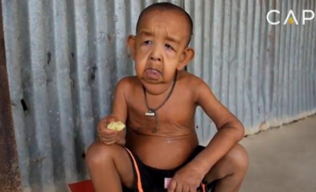 Ανήμπορη νιώθει η 18χρονη μητέρα του 4χρονου Bayezid Hossain που γεννήθηκε με μια απίστευτα σπάνια πάθηση. Ο γιος της, όπως εξηγεί, έμοιαζε με "εξωγήινο" όταν γεννήθηκε και λόγω της πάθησης μοιάζει με άντρα 80 ετών.