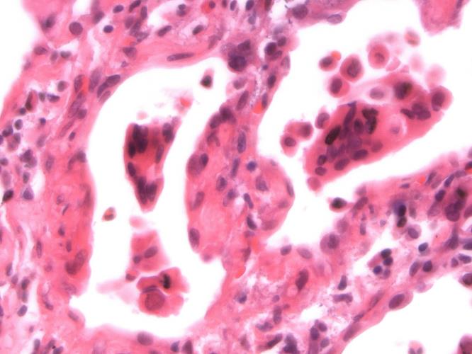 Αναγκαία όσο ποτέ η ευαισθητοποίηση για πρόληψη και έγκαιρη διάγνωση



