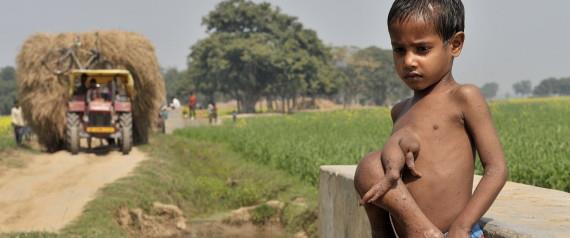 India's Second Octo Kid Appeals For Help